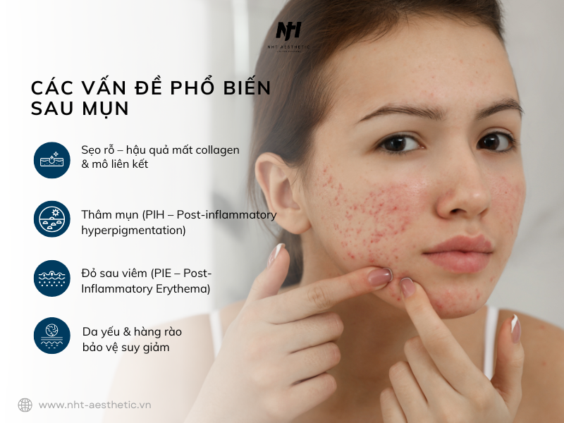 Các vấn đề phổ biến sau mụn
