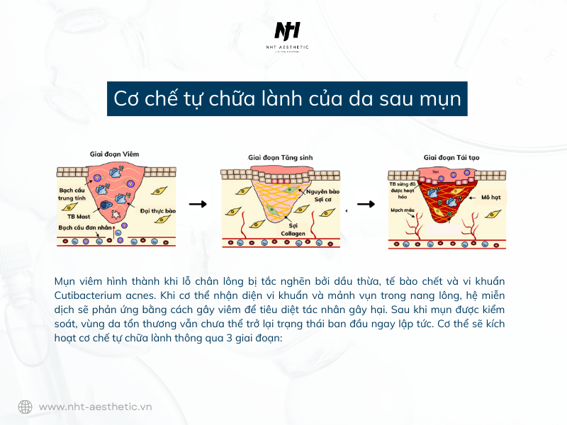 Cơ chế tự chữa lành của da sau mụn